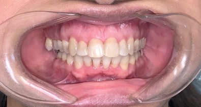 After Intraoral Smile- pt name - Berenice L.