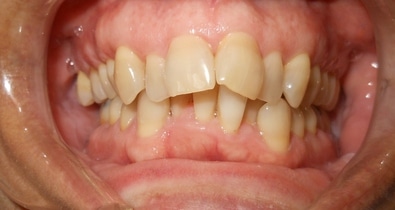 Before Intraoral Smile- pt name- Berenice L. Severe crowding correction