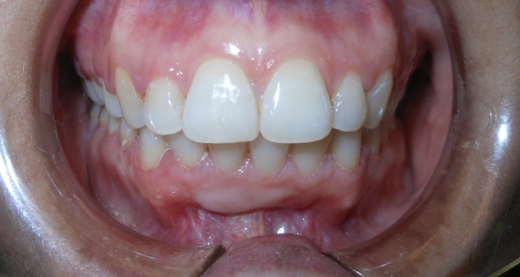 cornejoorthodontics_deepoverbite_after