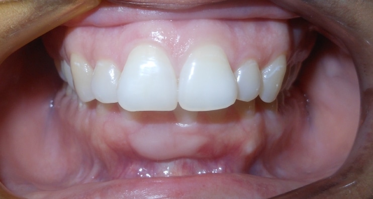 cornejoorthodontics_deepoverbite_before