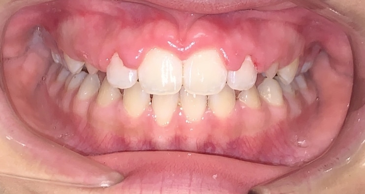 cornejoorthodontics_openbite_after